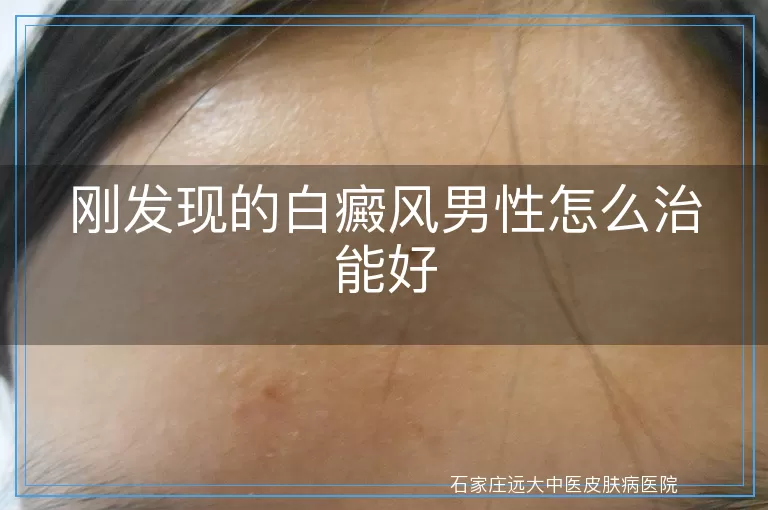 刚发现的白癜风男性怎么治能好