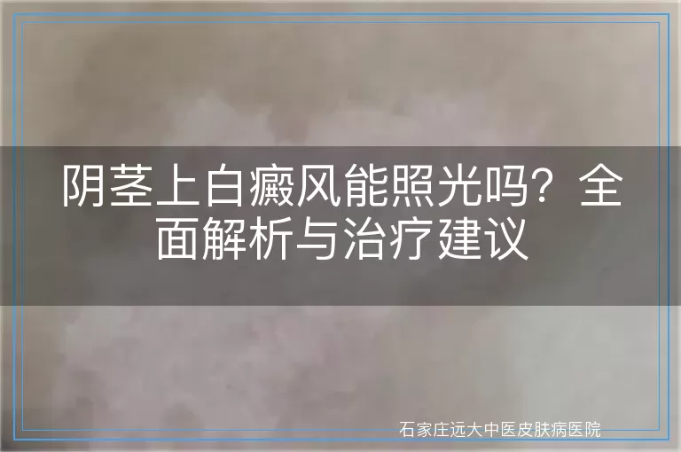 阴茎上白癜风能照光吗？全面解析与治疗建议