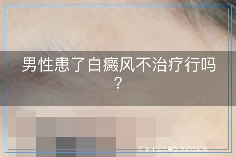 男性患了白癜风不治疗行吗？