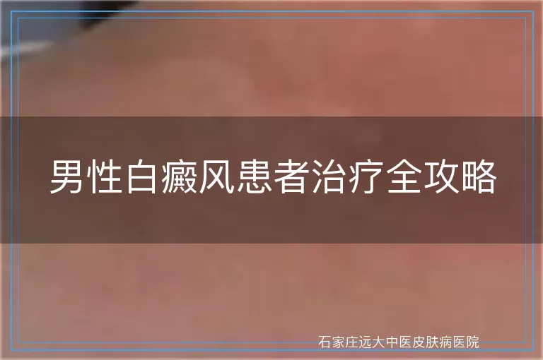 男性白癜风患者治疗全攻略