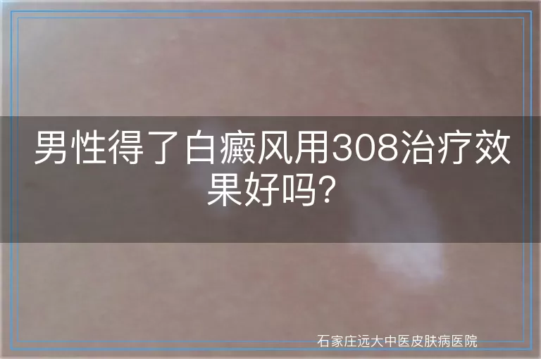 男性得了白癜风用308治疗效果好吗？