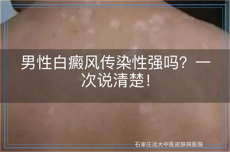 男性白癜风传染性强吗？一次说清楚！