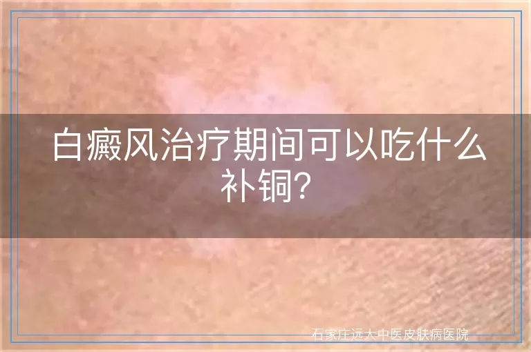 白癜风治疗期间可以吃什么补铜？