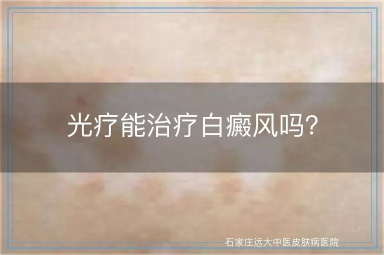 光疗能治疗白癜风吗？