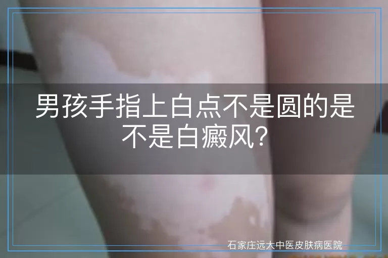 男孩手指上白点不是圆的是不是白癜风？