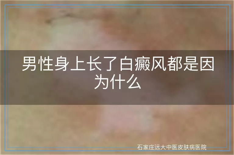 男性身上长了白癜风都是因为什么