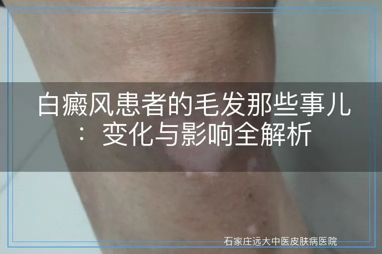 白癜风患者的毛发那些事儿：变化与影响全解析