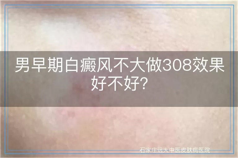 男早期白癜风不大做308效果好不好？