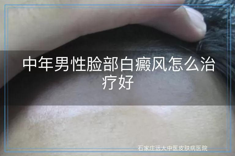 中年男性脸部白癜风怎么治疗好