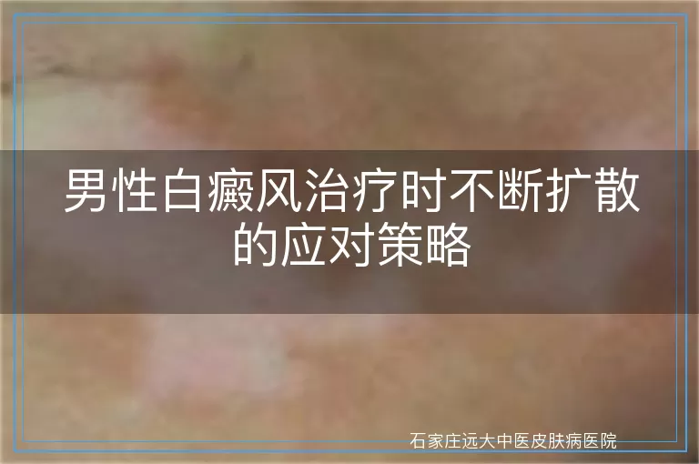 男性白癜风治疗时不断扩散的应对策略