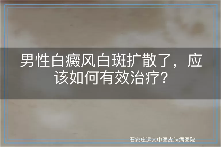 男性白癜风白斑扩散了，应该如何有效治疗？