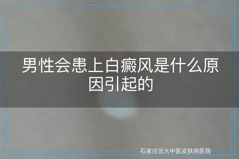 男性会患上白癜风是什么原因引起的