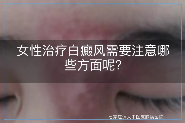 女性治疗白癜风需要注意哪些方面呢？