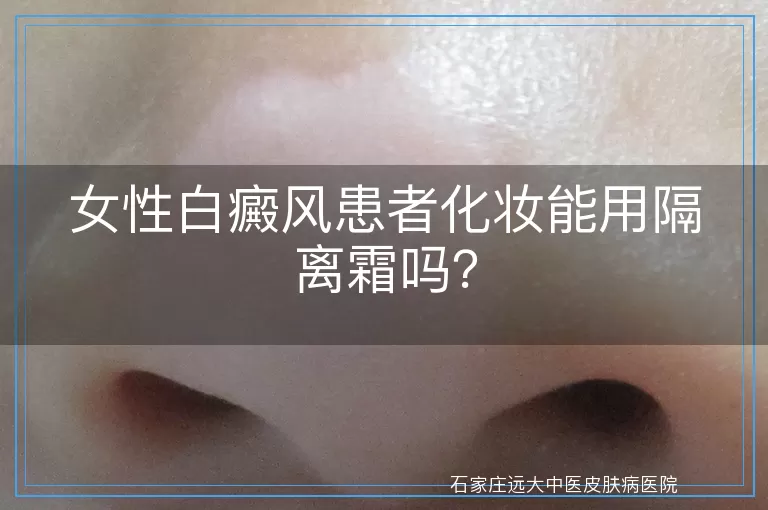 女性白癜风患者化妆能用隔离霜吗？