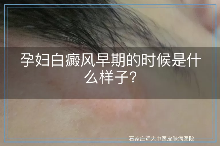 孕妇白癜风早期的时候是什么样子？