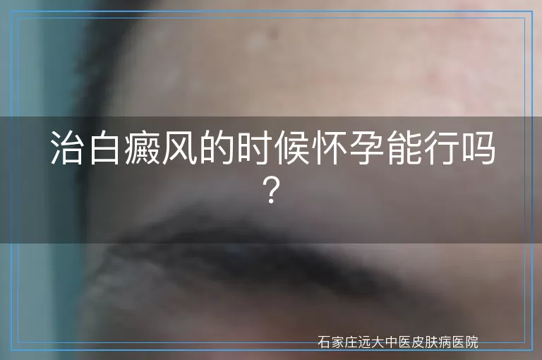 治白癜风的时候怀孕能行吗？