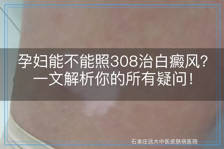 孕妇能不能照308治白癜风？一文解析你的所有疑问！