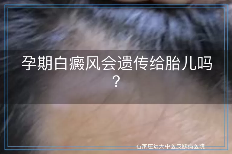 孕期白癜风会遗传给胎儿吗？