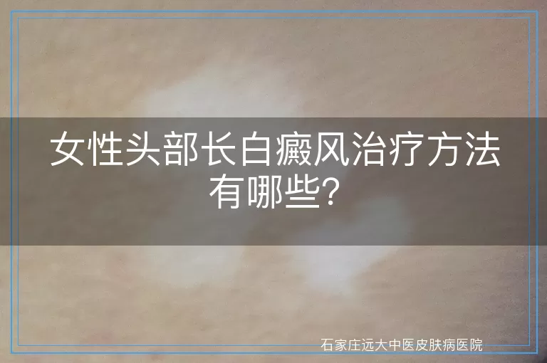 女性头部长白癜风治疗方法有哪些？