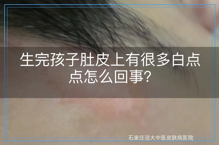 生完孩子肚皮上有很多白点点怎么回事？