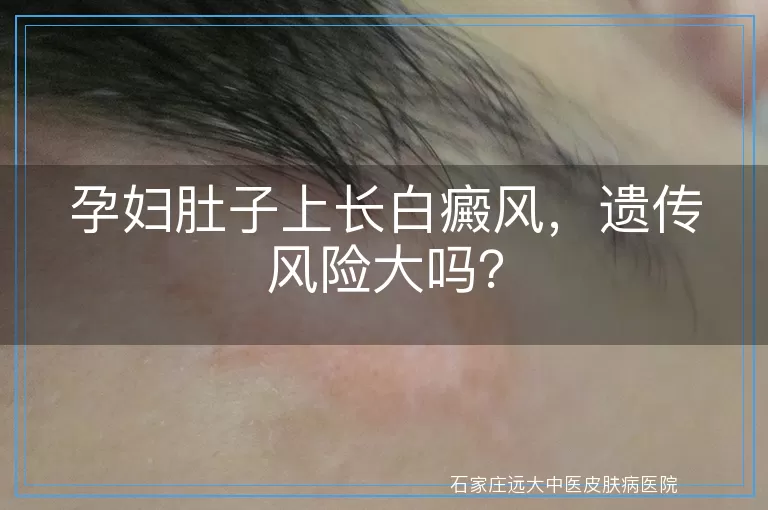 孕妇肚子上长白癜风，遗传风险大吗？