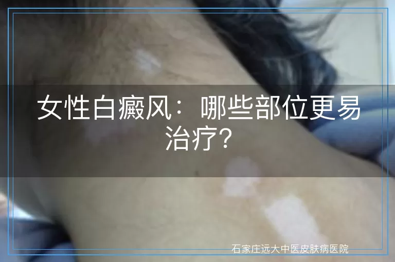 女性白癜风：哪些部位更易治疗？