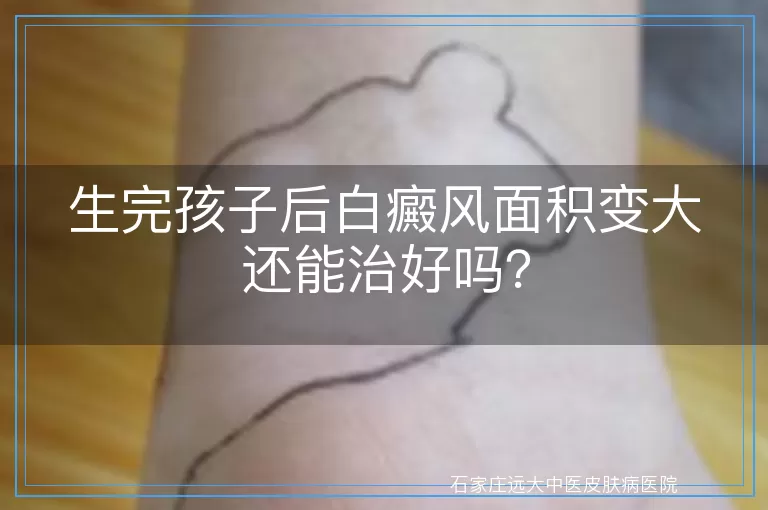 生完孩子后白癜风面积变大还能治好吗？