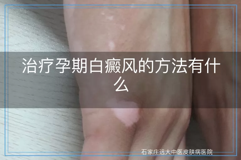 治疗孕期白癜风的方法有什么