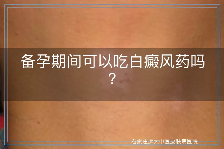 备孕期间可以吃白癜风药吗？