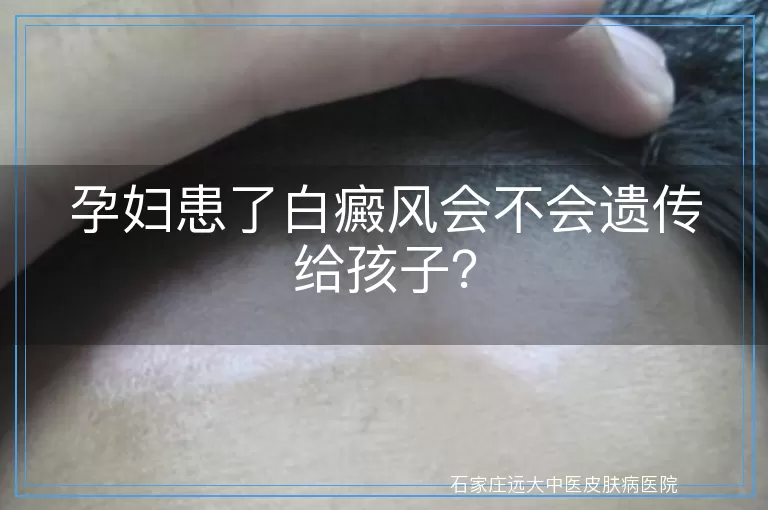 孕妇患了白癜风会不会遗传给孩子？