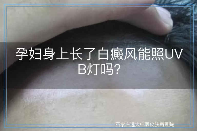 孕妇身上长了白癜风能照UVB灯吗？