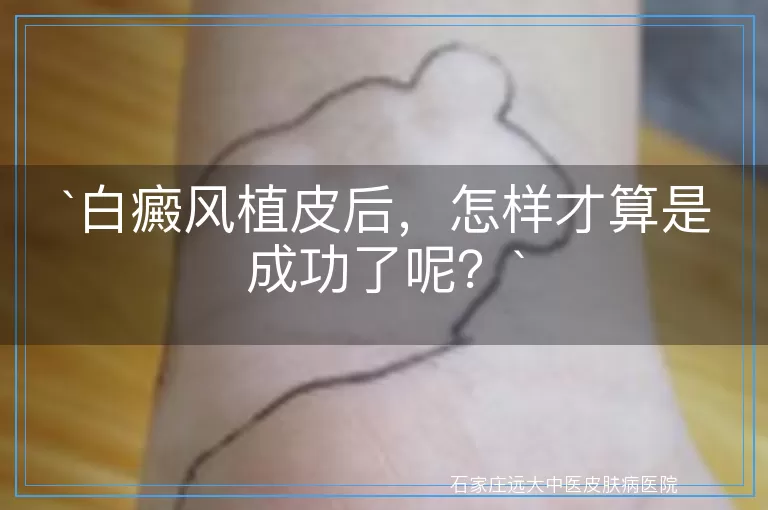 `白癜风植皮后，怎样才算是成功了呢？`