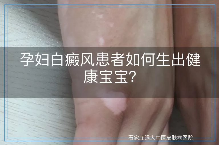 孕妇白癜风患者如何生出健康宝宝？