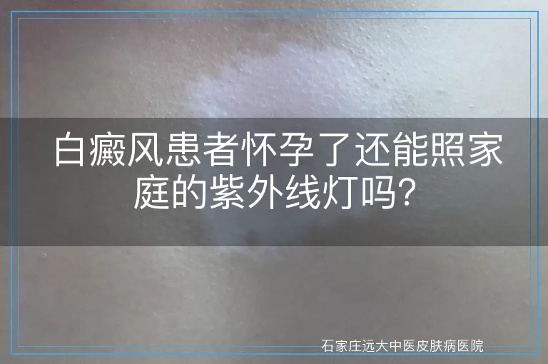 白癜风患者怀孕了还能照家庭的紫外线灯吗？