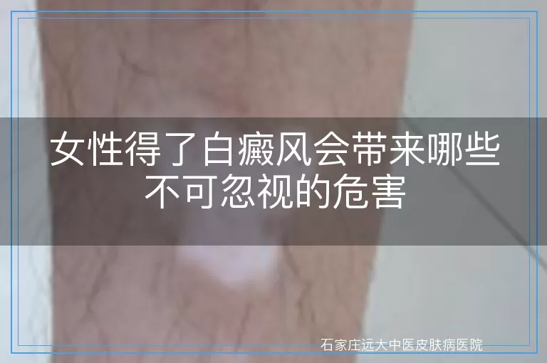 女性得了白癜风会带来哪些不可忽视的危害