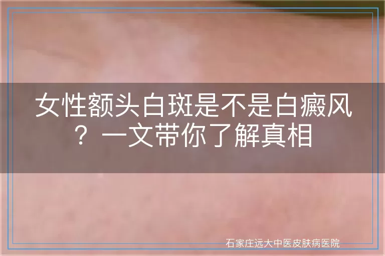 女性额头白斑是不是白癜风？一文带你了解真相