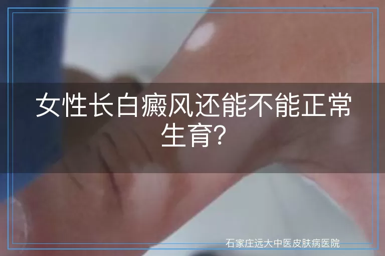 女性长白癜风还能不能正常生育？