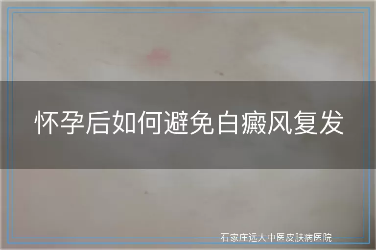 怀孕后如何避免白癜风复发