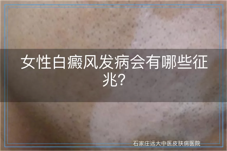 女性白癜风发病会有哪些征兆？