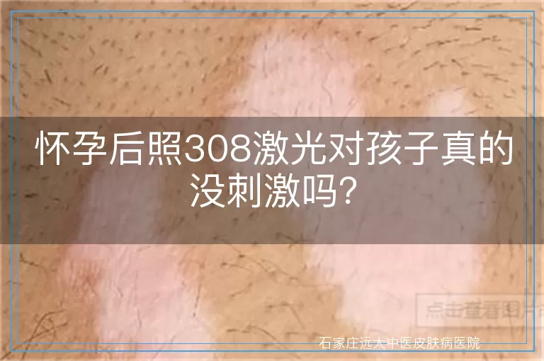 怀孕后照308激光对孩子真的没刺激吗？