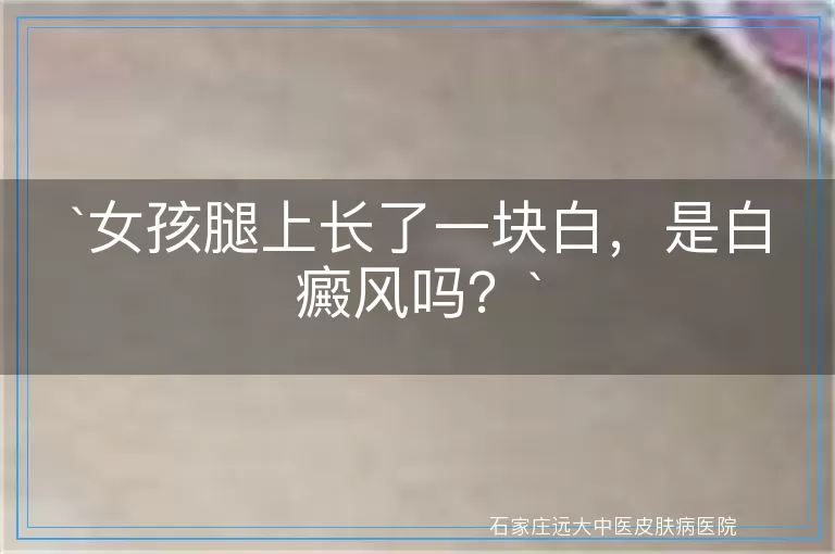 `女孩腿上长了一块白，是白癜风吗？`