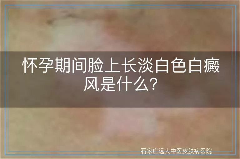 怀孕期间脸上长淡白色白癜风是什么？