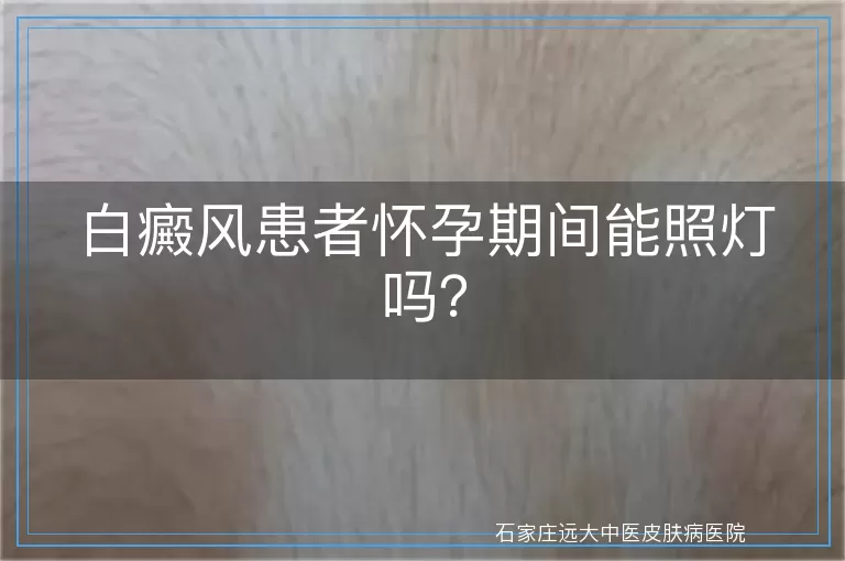 白癜风患者怀孕期间能照灯吗？