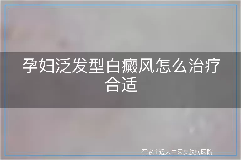 孕妇泛发型白癜风怎么治疗合适