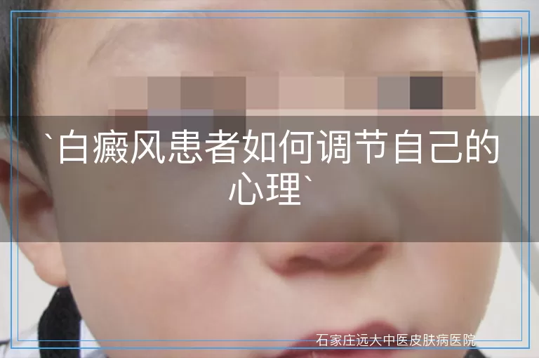 `白癜风患者如何调节自己的心理`