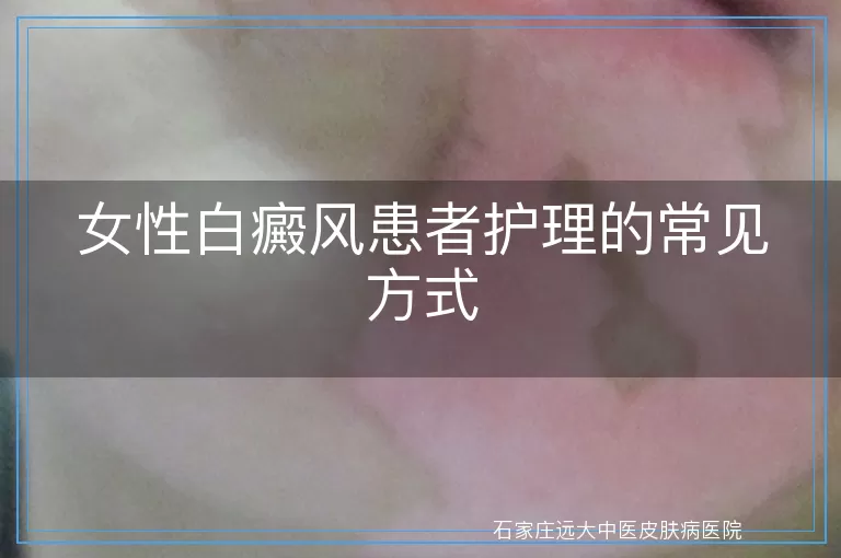 女性白癜风患者护理的常见方式