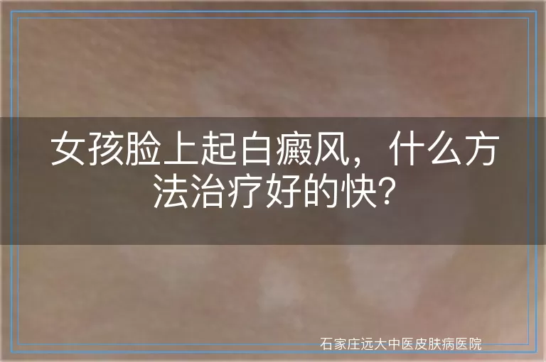 女孩脸上起白癜风，什么方法治疗好的快？