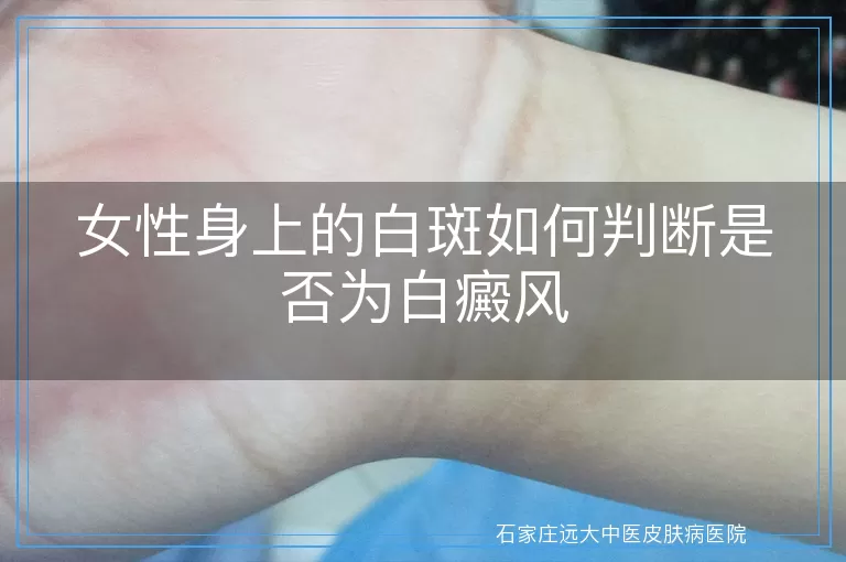 女性身上的白斑如何判断是否为白癜风