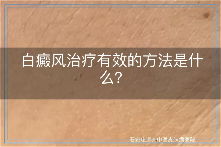 白癜风治疗有效的方法是什么？