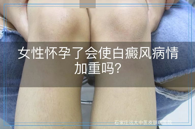 女性怀孕了会使白癜风病情加重吗？